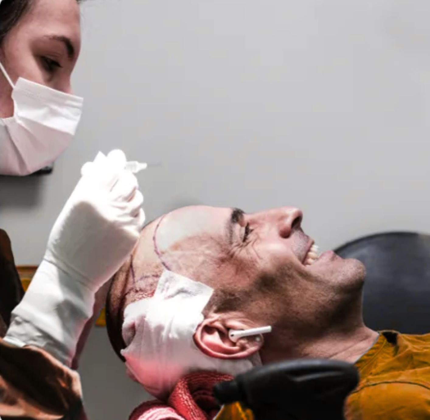 Comparison of FUE and Sapphire FUE techniques